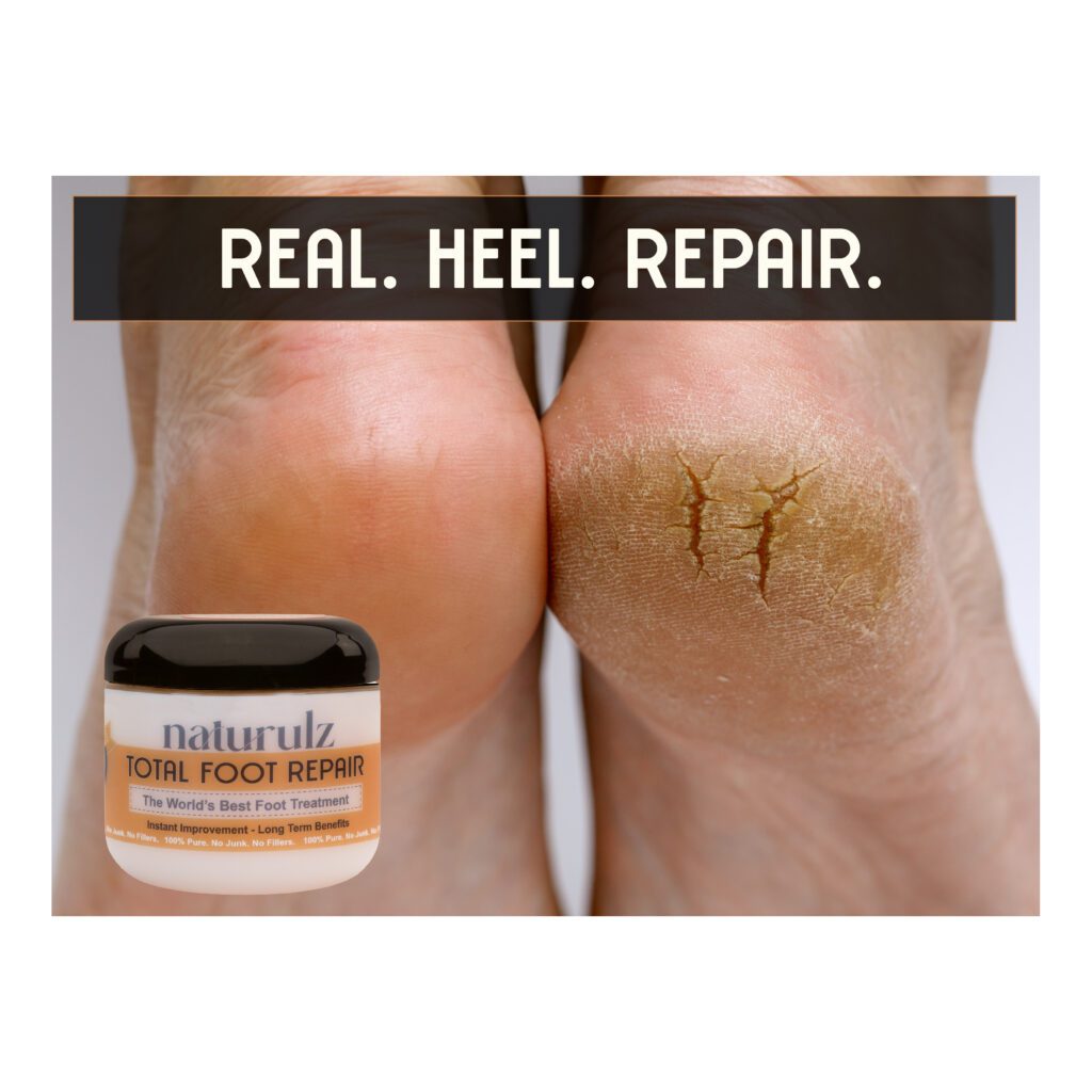 An image of cracked and dry skin next to a healthy heel with total foot repair in the foreground. The world's best foot treatment. 'NO JUNK', Diabetic Safe